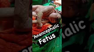 ANENCEPHALIC FETUS 🩺shortvideo children wala ।। Operation wala video ।। Anencephalic fetus ।।🙏🙏🙏 [upl. by Anelec]