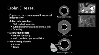 Small Bowel Inflammation [upl. by Yramesor]