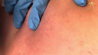 Ingrown Hair Removal  CNS  Episode 49 [upl. by Drofnil751]