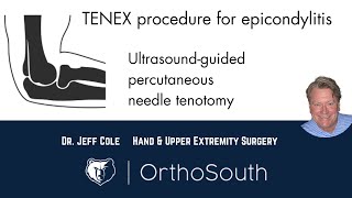 TENEX Procedure for Epicondylitis tennis and golfers elbowDr Jeff ColeOrthoSouth [upl. by Sanburn669]