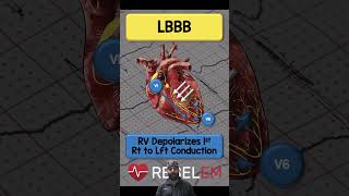 LBBB REBELEM ECG EKG BundleBranchBlock LBBB [upl. by Aramoiz]