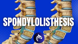 Understanding Spondylolisthesis amp Treatments 3D Animation [upl. by Tymothy601]