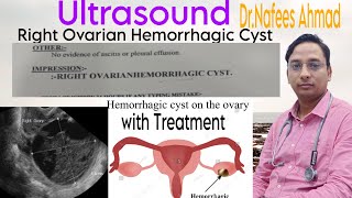 Ultrasound Right Ovarian Hemorrhagic Cyst doctor motivation viral ultrasound treatment [upl. by Tomas120]