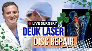 Cervical Disc Herniation  Deuk Laser Disc Repair C5C6 C6C7 [upl. by Airotcivairam]