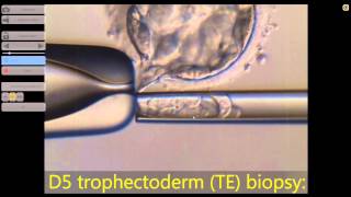 Hatching blastocyst biopsy [upl. by Oster]