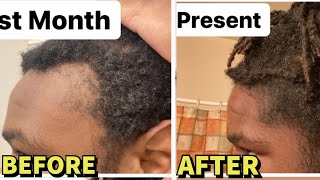 INSANE Microneedling BeforeAfter Results For Hair Regrowth MUST WATCH [upl. by Ellerad]