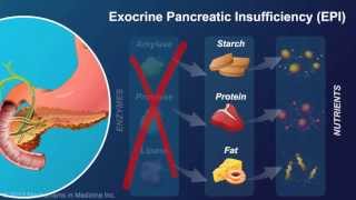 Exocrine Pancreatic Insufficiency [upl. by Aicire]