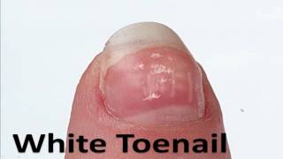 Most Common Toenail Problems  Home Treatment Guide [upl. by Adlig551]