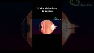 Treatment of Optic Neuritis [upl. by Ydnas]