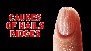 Causes of Ridged Nails and How to Avoid Them [upl. by Camilla584]