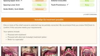 Invisalign Treatment Assessment Go iTero [upl. by Ahsimac]