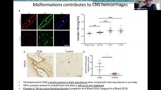 Blood thinners and Cerebral Cavernous Angioma Cavernoma Cavernous Malformation [upl. by Eserehc]