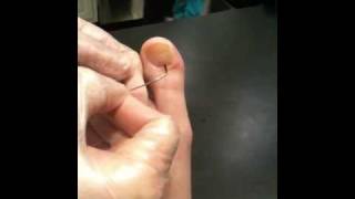 Draining a Subungual blister of toenail [upl. by Jarlen]