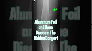 Aluminum Foil and Bone Disease The Hidden Danger [upl. by Ruford]