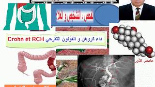 La Cholangite sclérosante primitive et maladies inflammatoires chroniques de lintestin [upl. by Immac]