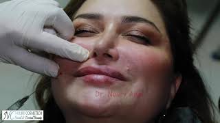 Nasolabial fold filler using restylane defyne  Dr Noury Adel [upl. by Tuhn]