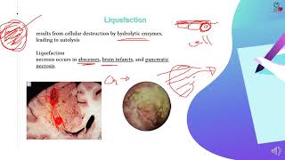 8Cell Death Necrosis Liquefactive Caseous Fat 2 1 [upl. by Pendleton]