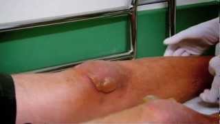 Burn Blisters  Part 1  Bizarre ER [upl. by Neila]