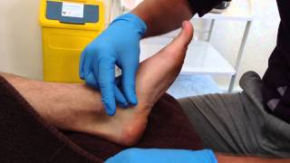 Dry Needling Abductor Hallucis [upl. by Lynett23]