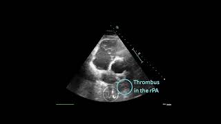 〖Echocardiography〗 Acute pulmonary embolism with a thrombus in the right pulmonary artery 🏥 [upl. by Kred]