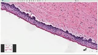 Odontogenic Keratocyst  Histopathology [upl. by Nerw]