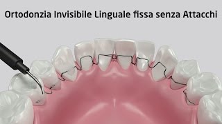 Ortodonzia Invisibile Linguale fissa senza Attacchi  Zerodonto [upl. by Bertine]