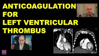 Management of LEFT VENTRICULAR Thrombus by DR NIK NIKAM 2024 [upl. by Irep]