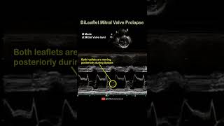 BiLeaflet Mitral Valve Prolapse echocardiography cardiology [upl. by Marucci]