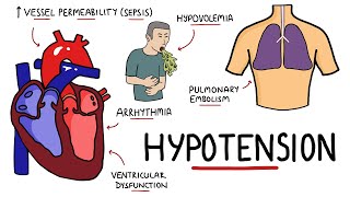 Causes of Hypotension  What causes Low Blood Pressure with Signs and Symptoms [upl. by Ahseyd855]