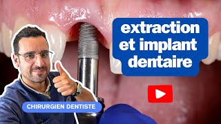 Extraction et implantation immédiate  une solution optimale [upl. by Liagibba]