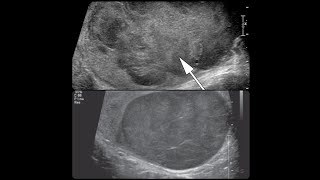 BOLITA EN EL TESTÍCULO MARCADORES TUMORALES PARA CANCER TESTICULAR [upl. by Evans700]