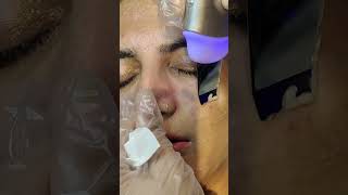 What does a Hydra facial do  Hydrafacial Step By Step Procedure [upl. by Barling]