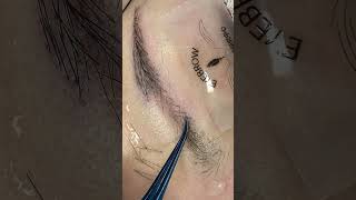 eyebrow transplantation eyebrow eyebrows eyelashes eyebrowtransplantation hairtransplantation [upl. by Ysabel]