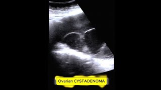 OVARIAN CYST ADENOMA mass infertility ovarian [upl. by Nickolas]