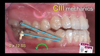 Solving anterior Crossbite with Aligners｜【Chris Chang Ortho】CC808 [upl. by Goerke]