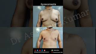 Gynecomastia surgery results day 3 [upl. by Ann-Marie155]