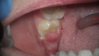 whats this sore gum on wisdom tooth  pericoronitis [upl. by Airt]