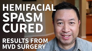 Hemifacial Spasm Surgery Recovery  Hemifacial Spasm Stories and MVD Surgery Cure [upl. by Jena]