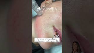 Microneedling is a minimally invasive treatment that uses very fine needles to create tiny punctures [upl. by Ahsitruc]