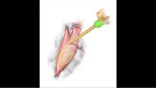 BioGlues Role as a Surgical Sealant in Vascular Surgery [upl. by Ynaffad]