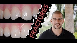 How to Repair a Broken Tooth with Dentist Filling Dentist [upl. by Ayaladnot]