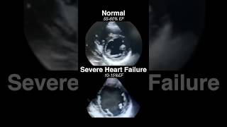 Echocardiogram NORMAL vs SEVERE HEART FAILURE radiology cardiology [upl. by Norag]