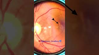 Macular Pathology  macular scar  Fundus Videography  Fundus Photography  Short Video 143 viral [upl. by Einwat]