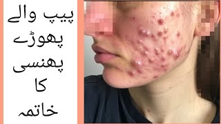 pus pimples and abscess  Homeo Treatment  DrSohail Janjua [upl. by Eelyme983]