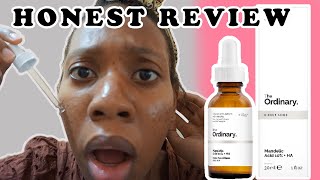 I TRIED THE ORDINARY MANDELIC ACID 10 FOR MY ACNE EVERYDAY FOR 2 WEEKS THESE ARE MY RESULTS [upl. by Suiradel]