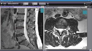 How to Read Your MRI with Onis 25  part 2 of 2 Advanced Lumbar Spine MRI Anatomy [upl. by Ahsiloc]