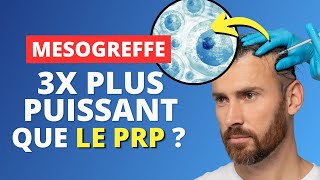 Calvitie  La Mésogreffe  Nouvelle révolution antichute  😱 [upl. by Prud610]