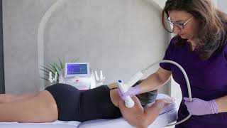 SharpLight Radio Frequency Underarm Treatment [upl. by Noruq]