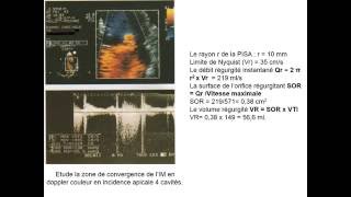 CARDIOLOGIE INSUFFISANCE MITRALE [upl. by Attenrev]