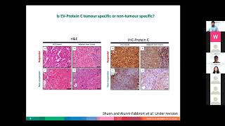 Translational Analysis of Yttrium90 Treatment in Hepatocellular Carcinoma [upl. by Sylvan527]